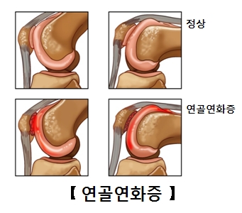 연골연화증