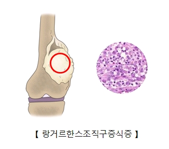 랑거한스세포조직구증식증