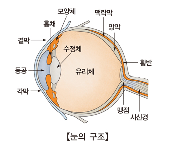 각막 부종