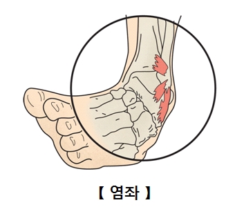 염좌