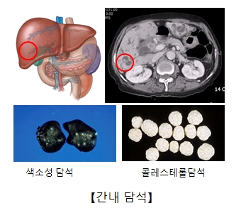 간내 담석