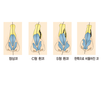 비 변형