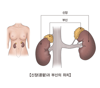 부신 기능부전