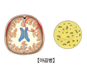 야곱병