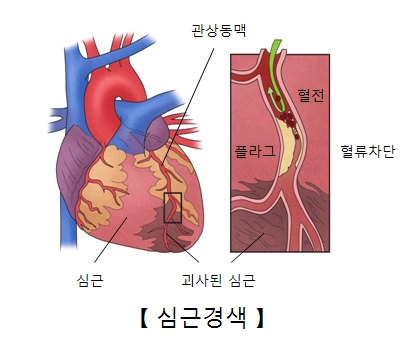 오래된 심근경색증