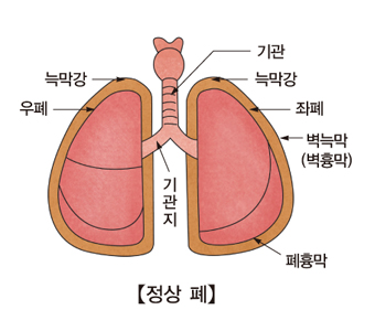 악성 흉막삼출