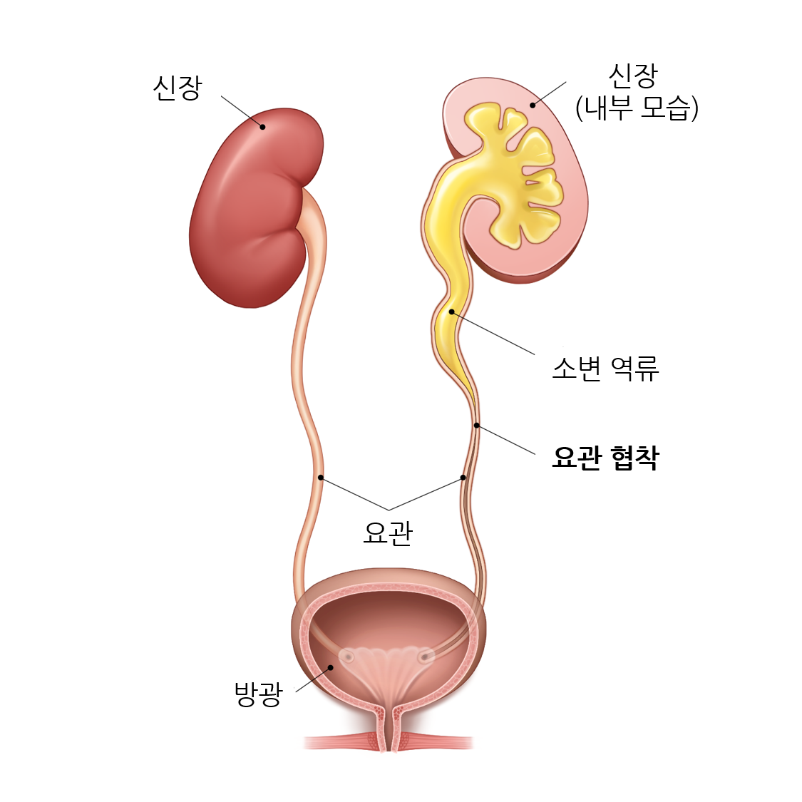 요관 협착