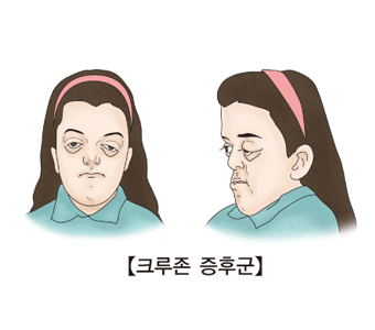 크루존 증후군